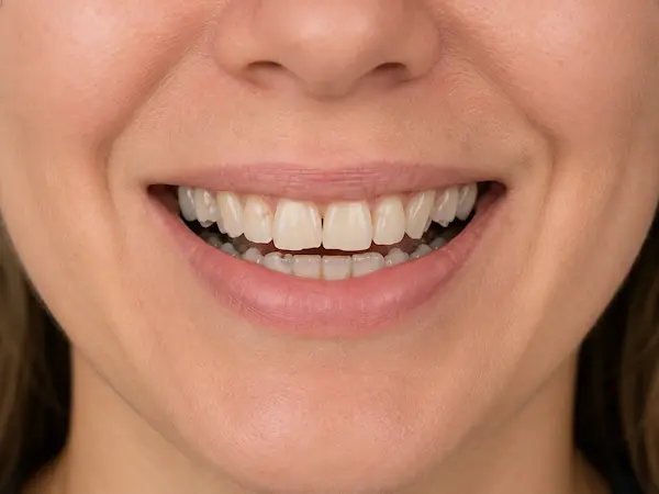 DentalPro Facing behandeling ervoor