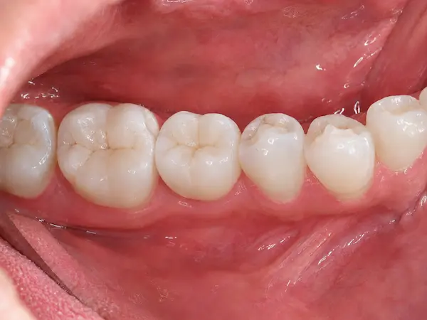 DentalPro Implantaten behandeling erna DentalPro Implantaten behandeling erna