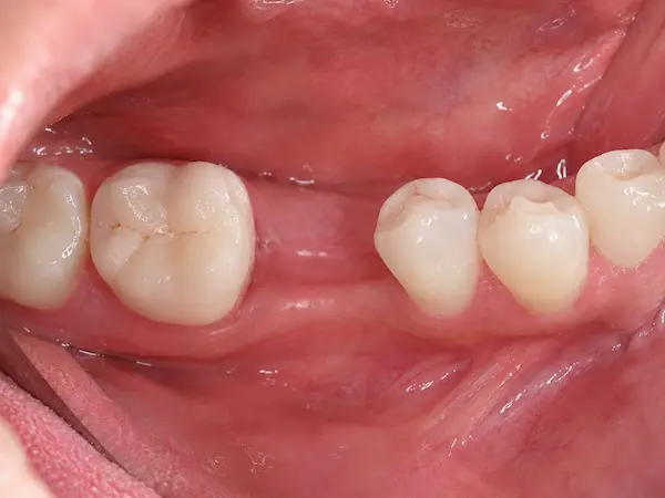 DentalPro Implantaten behandeling ervoor DentalPro Implantaten behandeling ervoor