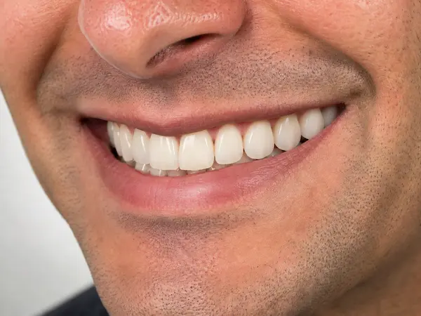 DentalPro Kronen en bruggen erna