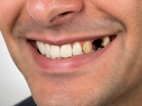 DentalPro Kronen en bruggen ervoor