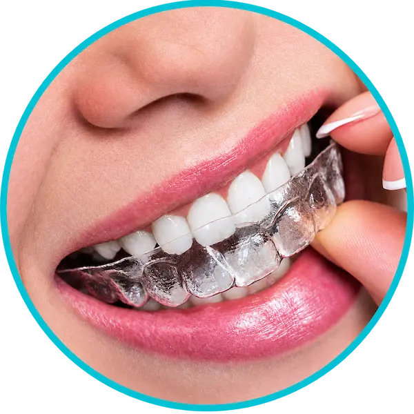 DentalPro Voorburg Onzichtbare beugel