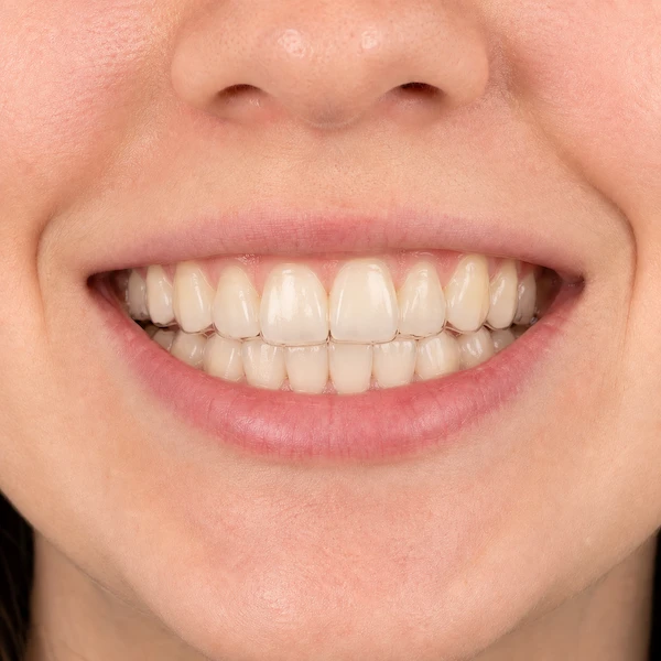 DentalPro onzichtbare beugel erna