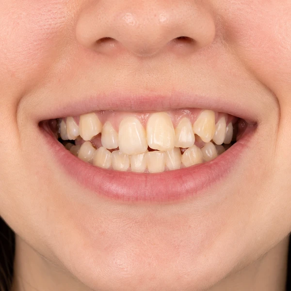 DentalPro onzichtbare beugel ervoor