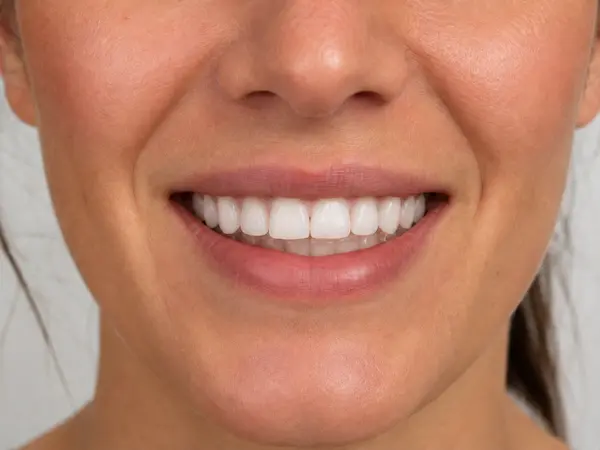 DentalPro tanden bleken behandeling erna