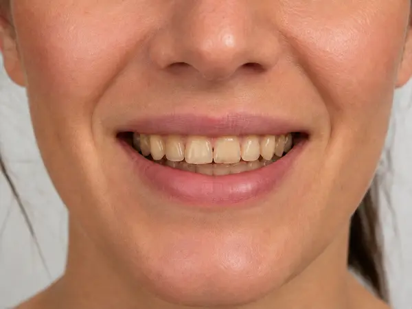 DentalPro tanden bleken behandeling ervoor